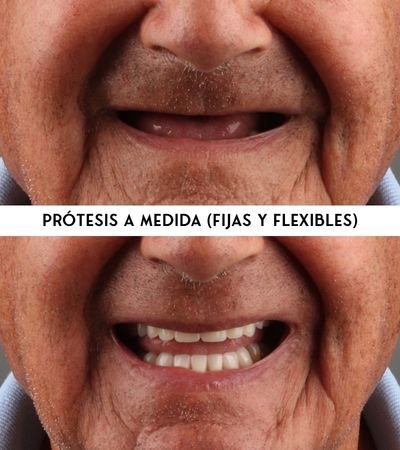 Prótesis a medida (fijas y flexibles)